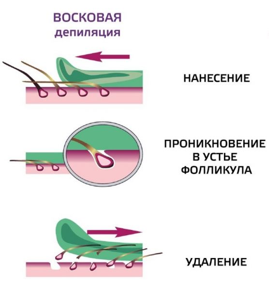 Схема восковой депиляции