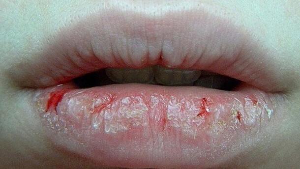 Чрезмерно сухая кожа губ