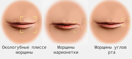Морщины вокруг рта: кисетные, марионетки, носогубные