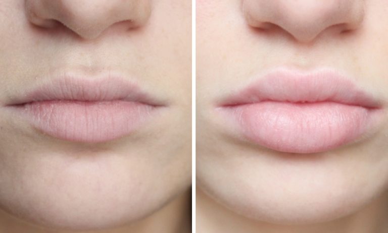 7 модных форм губ, добиться которых можно при увеличении у косметолога