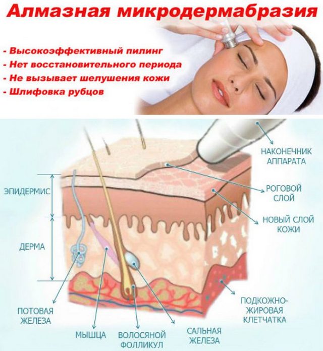 алмазный пилинг - микродермабразия